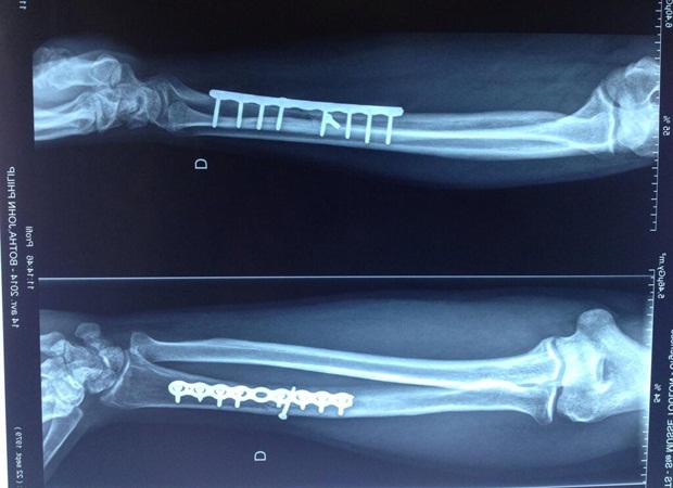 Botha's X-ray showing nine metal pins holding the metal plate in place. (Bakkies Botha via Twitter)